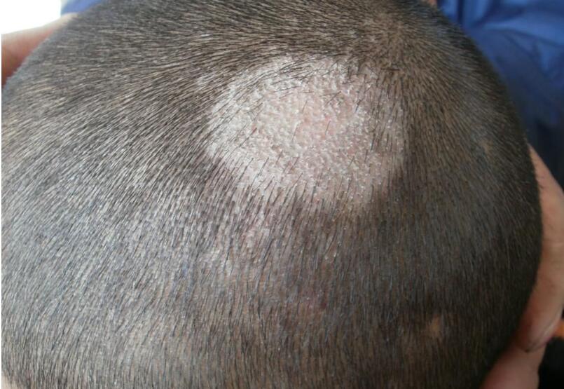 细说11种常见的真菌性皮肤病!