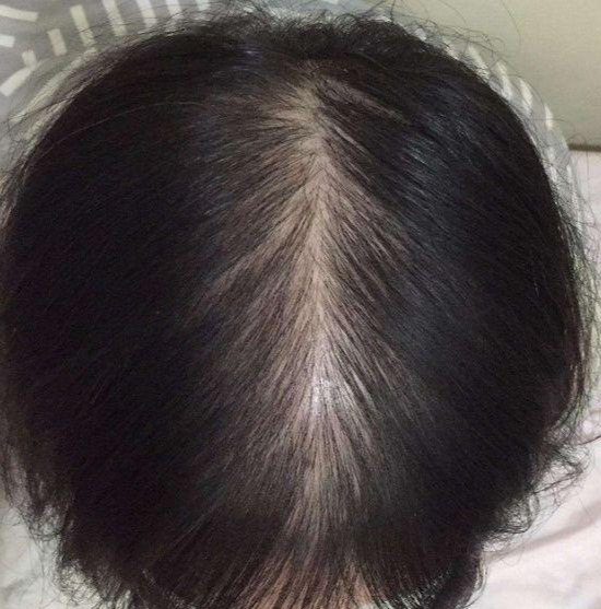 女朋友脱发很严重,如何科学有效的养发护发?