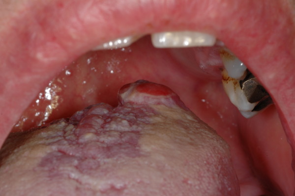 口腔hpv感染的症状图片
