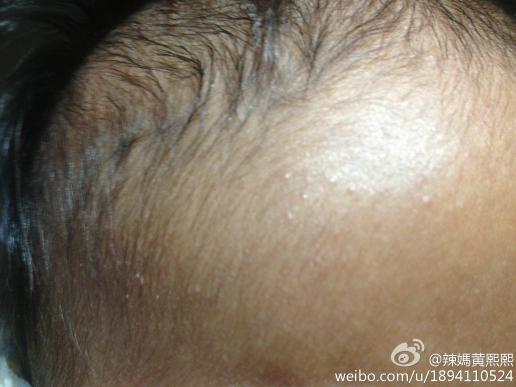  宝宝出生一个月额头上起了鼻子以上部位起了很多小红疹怎?