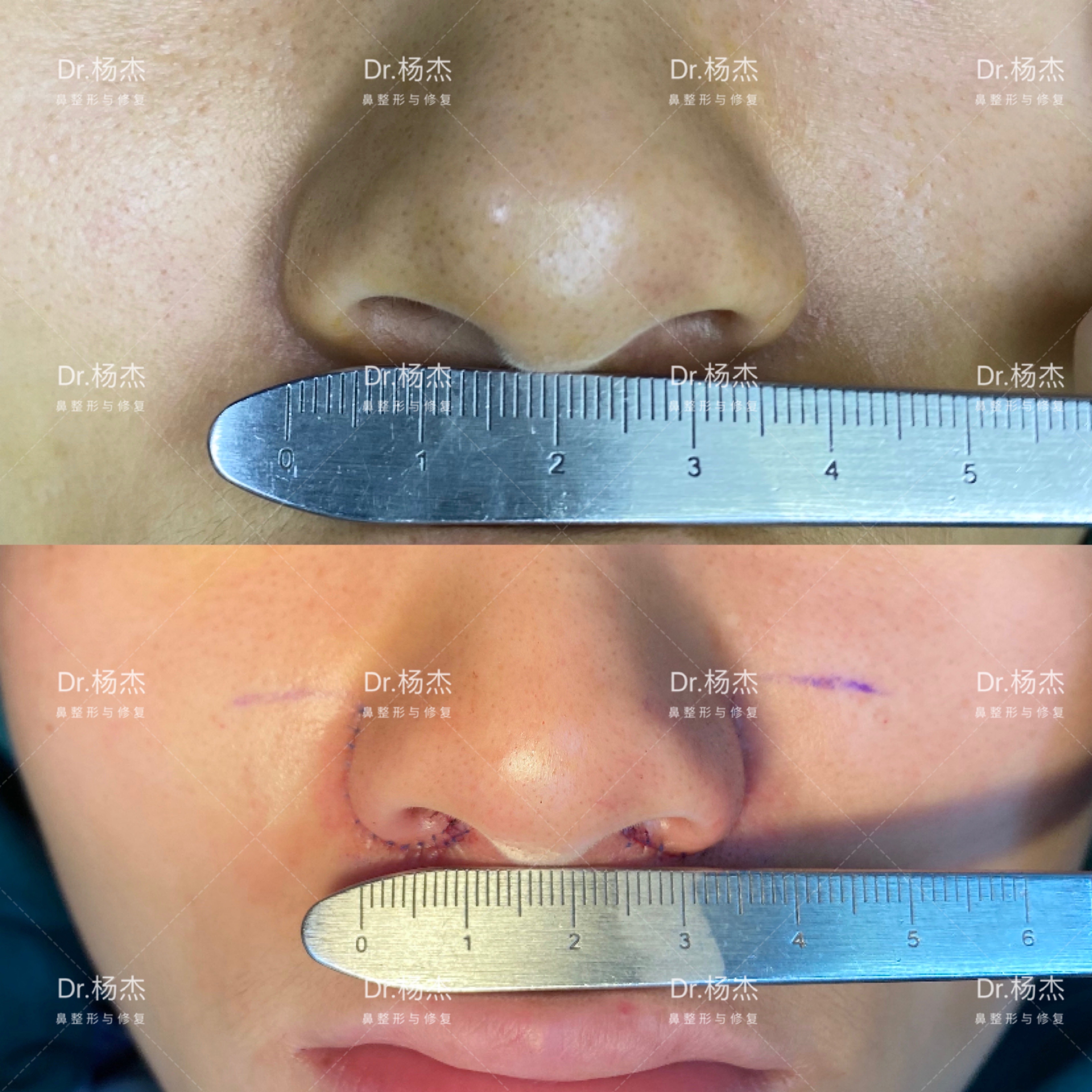 医生心得手术采取鼻翼内外联合切除:1.