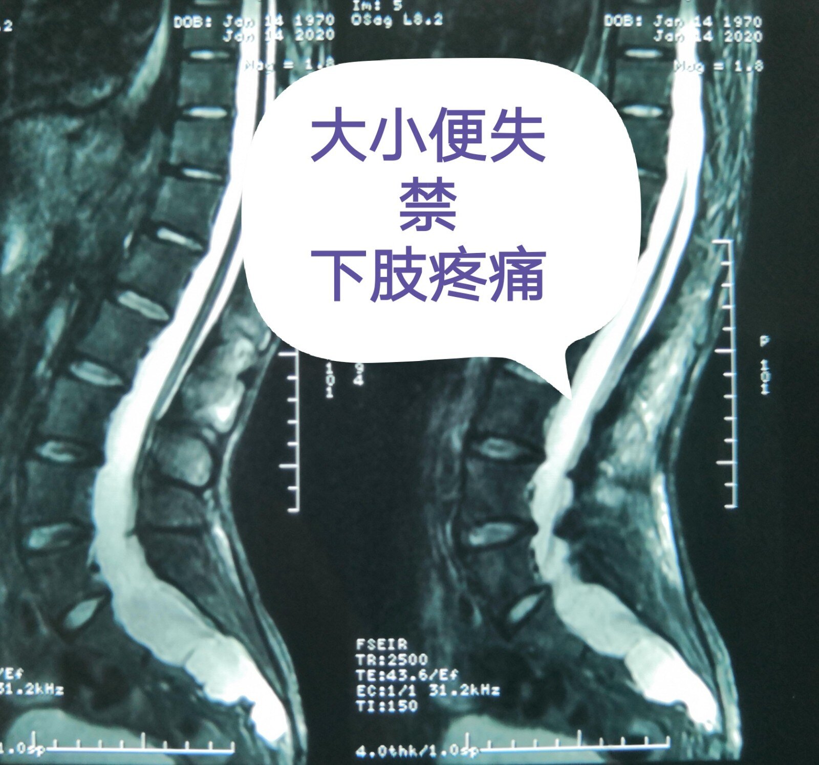 图1-2-2 椎间盘、前纵韧带和椎骨间的连结-新编人体解剖学-医学