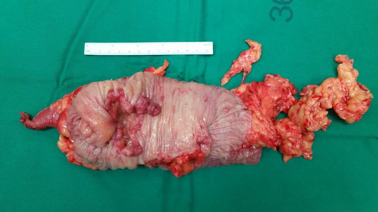 肠系膜上动脉变异的升结肠癌手术