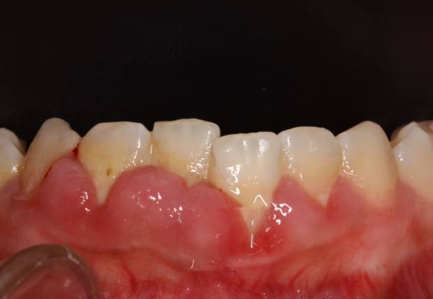 其实,牙龈长脓包一般有以下两种情况:①牙根发炎:由于细菌感染牙髓