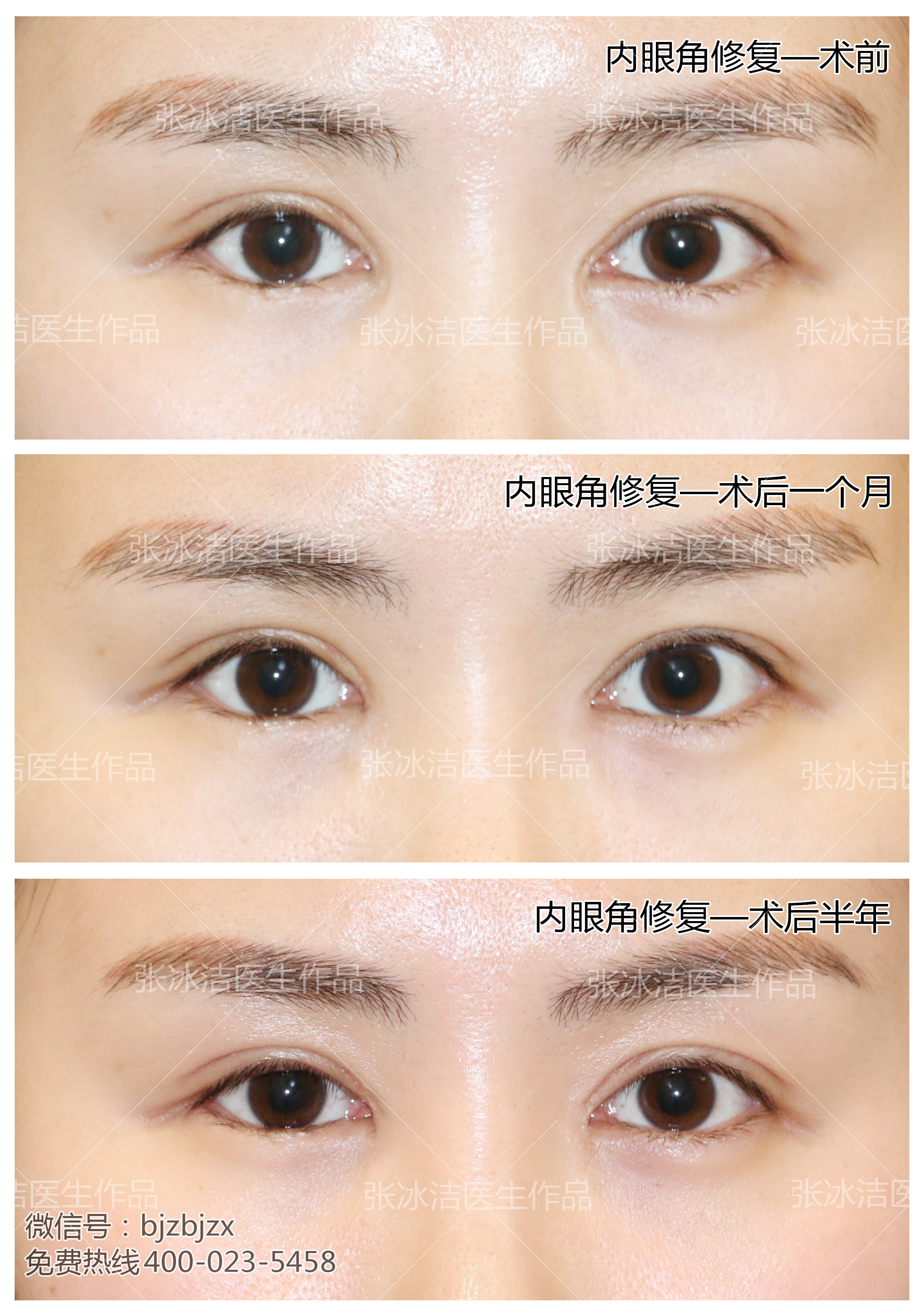 内眼角修复 | 内眼角疤痕修复部分案例-张冰杰主治医师-爱问医生