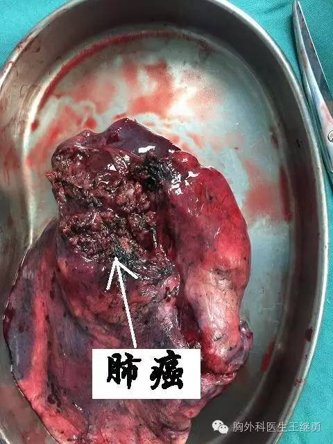 肺腺癌 手术图片