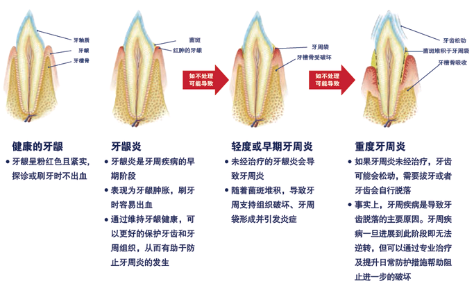 引起牙齒脫落的罪魁禍首正其實是牙周病,又稱牙周炎.