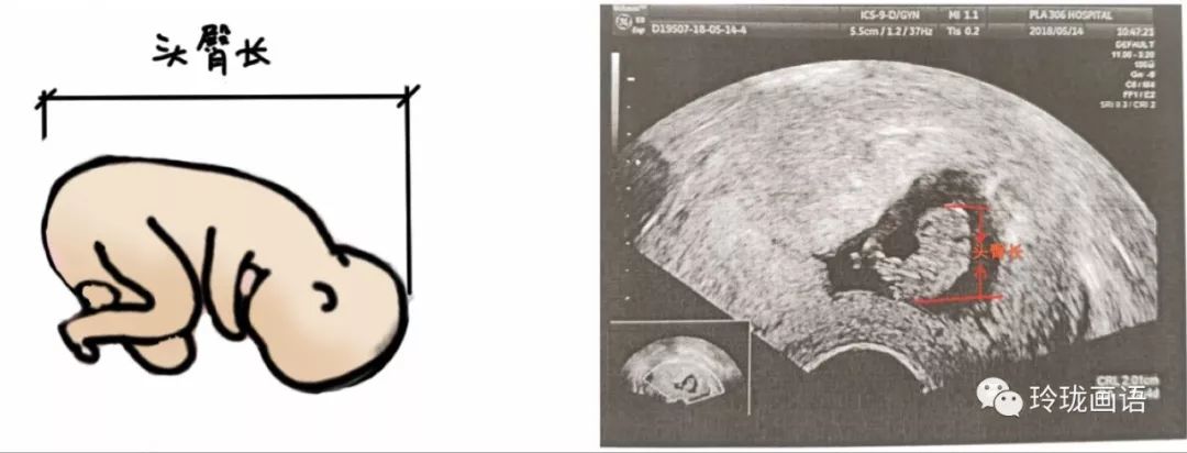 头臀长(crown-rump length crl)