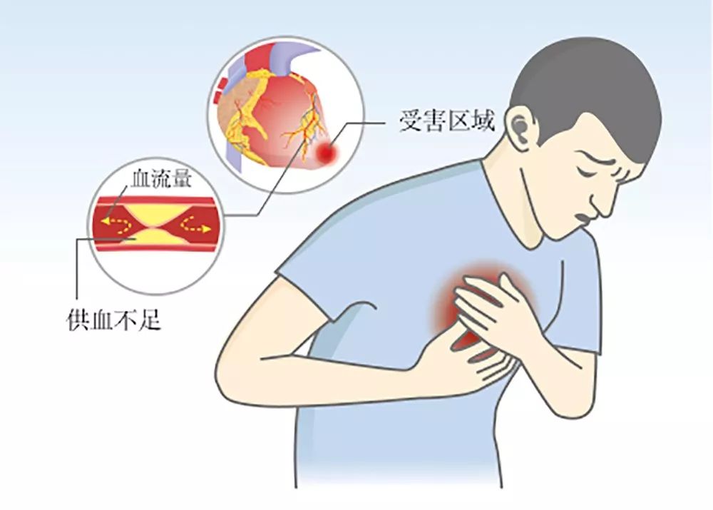 乏力或是心衰信号 五大症状要警惕