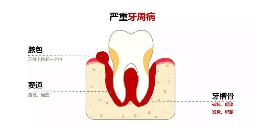 牙齦上的膿包好嚇人!要怎麼辦呢?