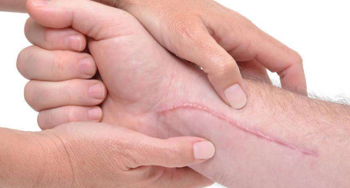 瘢痕的表现是多种多样的,一般大致分为生理性瘢痕和病理性瘢痕.