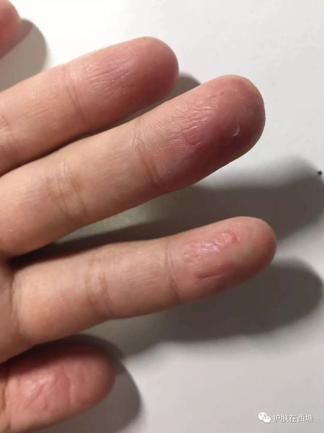 "手脱皮"究竟是怎么回事