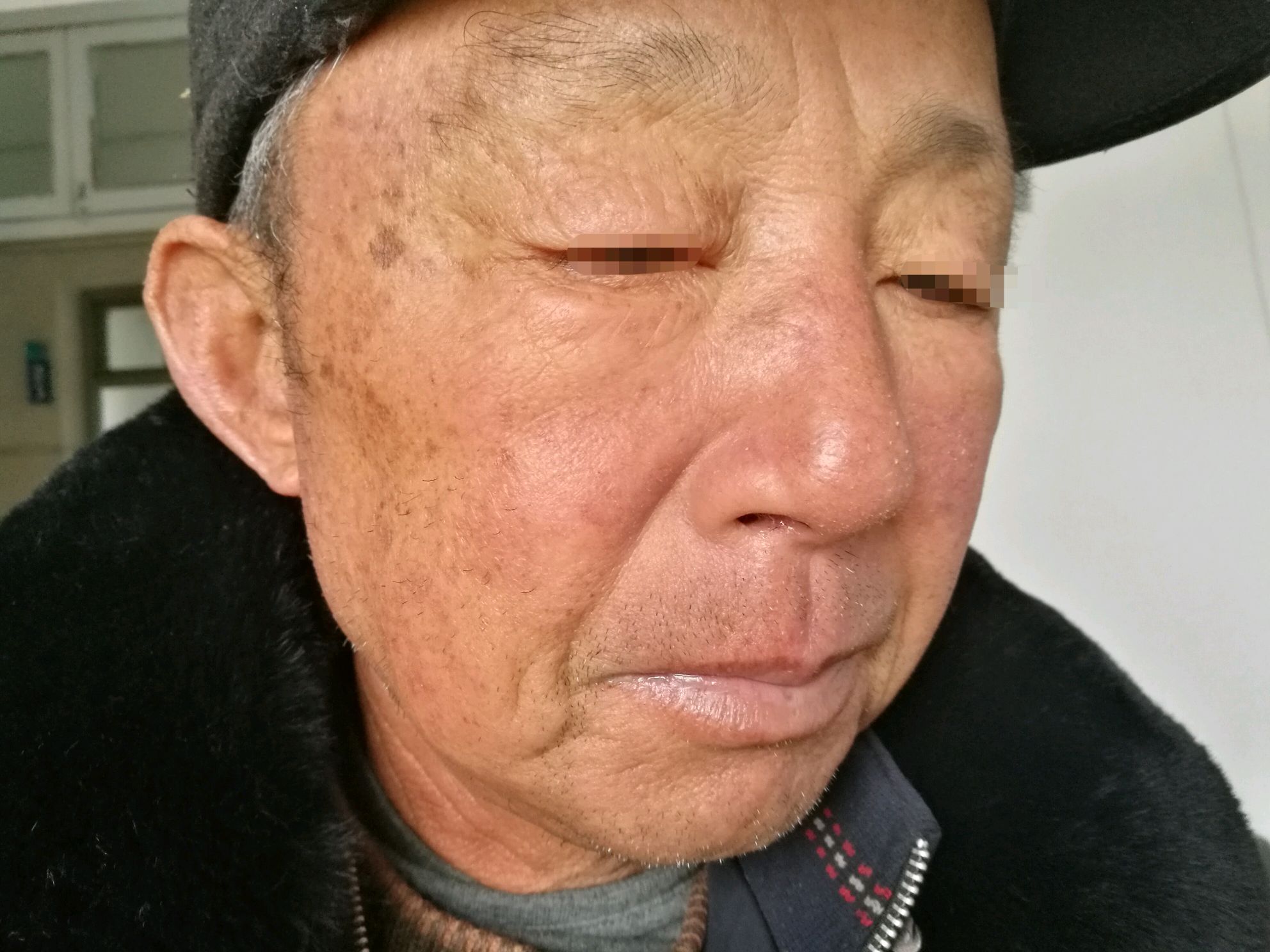 因高血压病入院治疗,后用厄贝沙坦氢氯噻嗪至今.