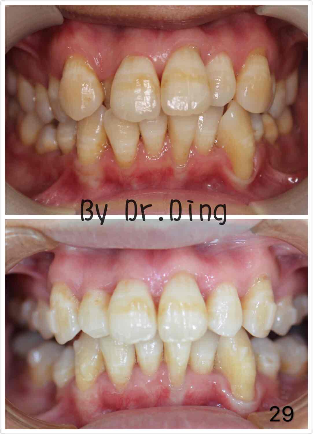 夏日健康贴士-牙齿慢慢排整齐