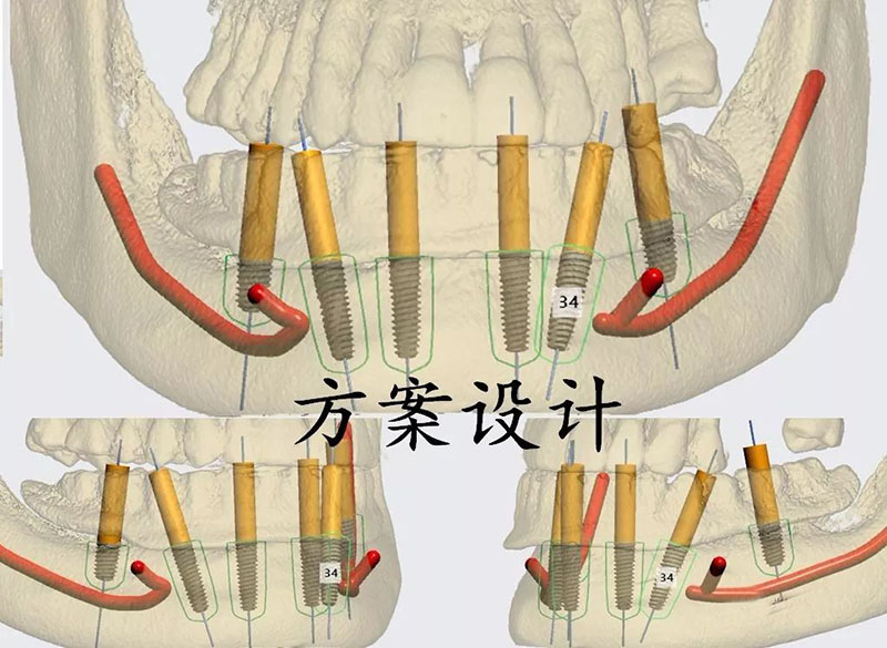爱牙故事夏常觉院长下颌即刻负重导板种植病例
