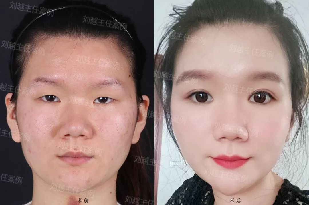 松垂的皮肤得到改善,眼睛更加年轻有神;●上睑下垂矫正后,黑眼球