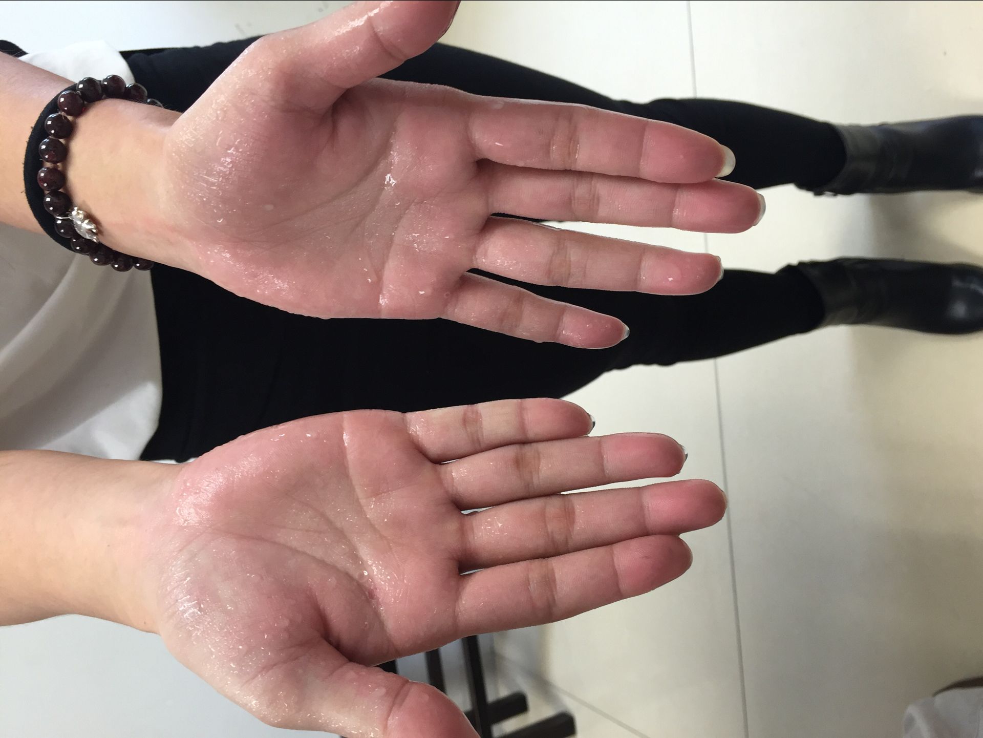 手汗症,腋汗症是由于胸交感神经过度兴奋引起的,目前最有效彻底的方法