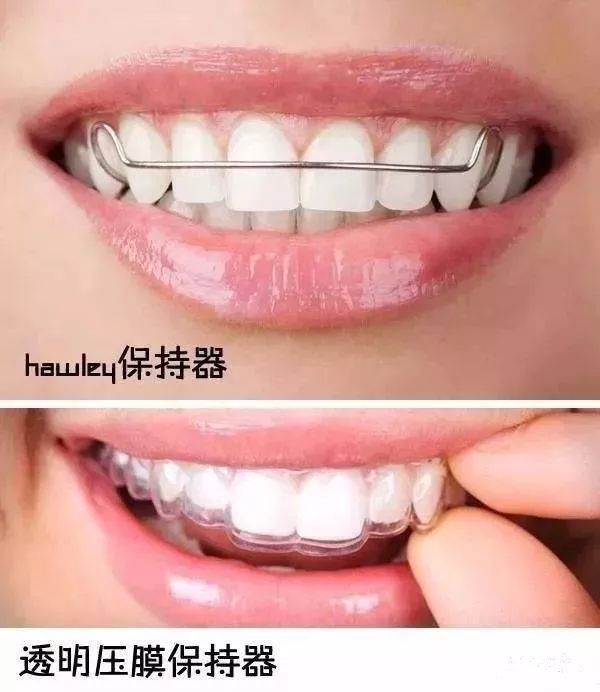 说戴牙套牙齿会松掉的人,一定是妒忌你美貌吧?