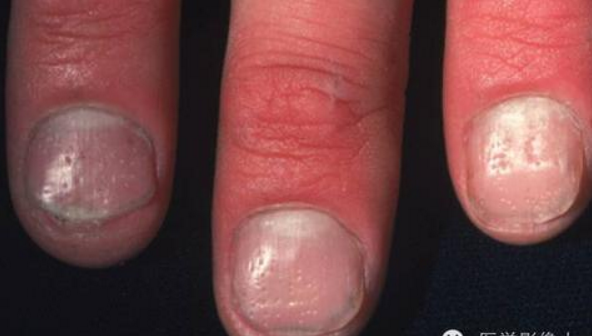 怎样通过指甲的改变来关注健康?