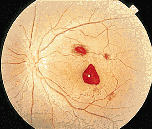 玻璃体混浊有哪些并发症