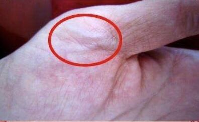 大鱼际干瘪,凹陷,一般都代表胸廓小,生命力弱,免疫力差,肺活量不行,没