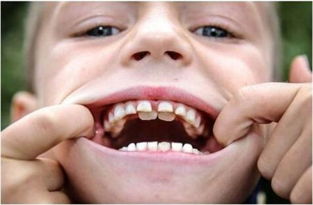 多生牙多为畸形牙,它们占据了正常牙的位置,致使这些正常的牙齿出现