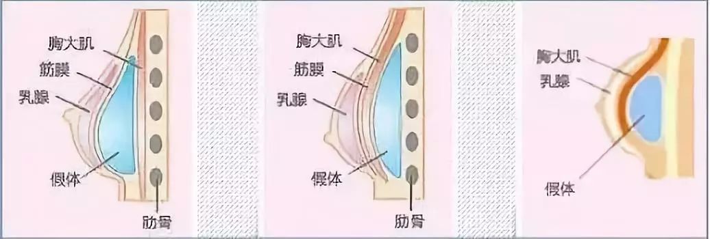 面部手术除皱需要多少钱_额面部除皱术_面部除皱术价格