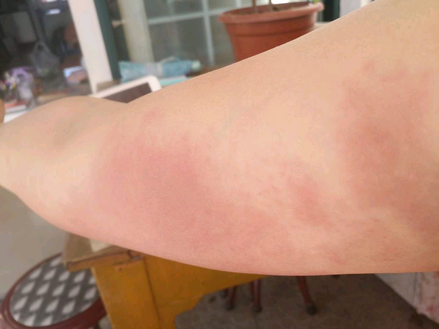 乳腺癌术后上肢红肿咋回事啊?怎么办啊?_邓荣_副主任医师_爱问健康