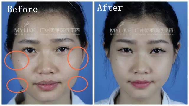 额骨高轮廓型大脸 ▼ 变小脸只能靠v-line小脸术