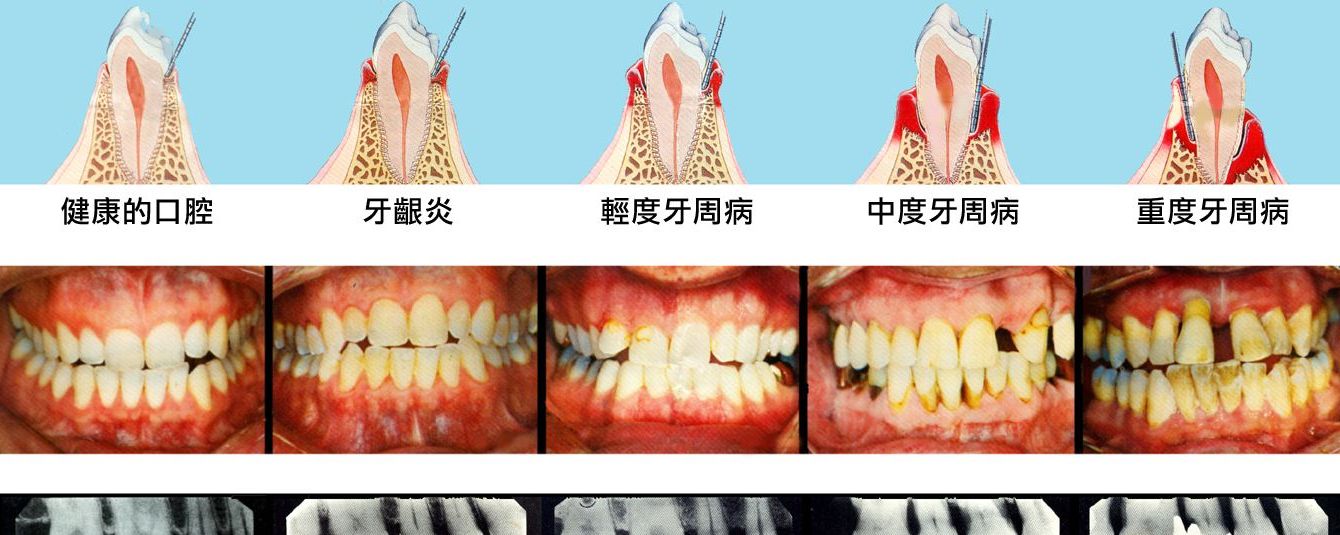 牙龈萎缩能治吗?