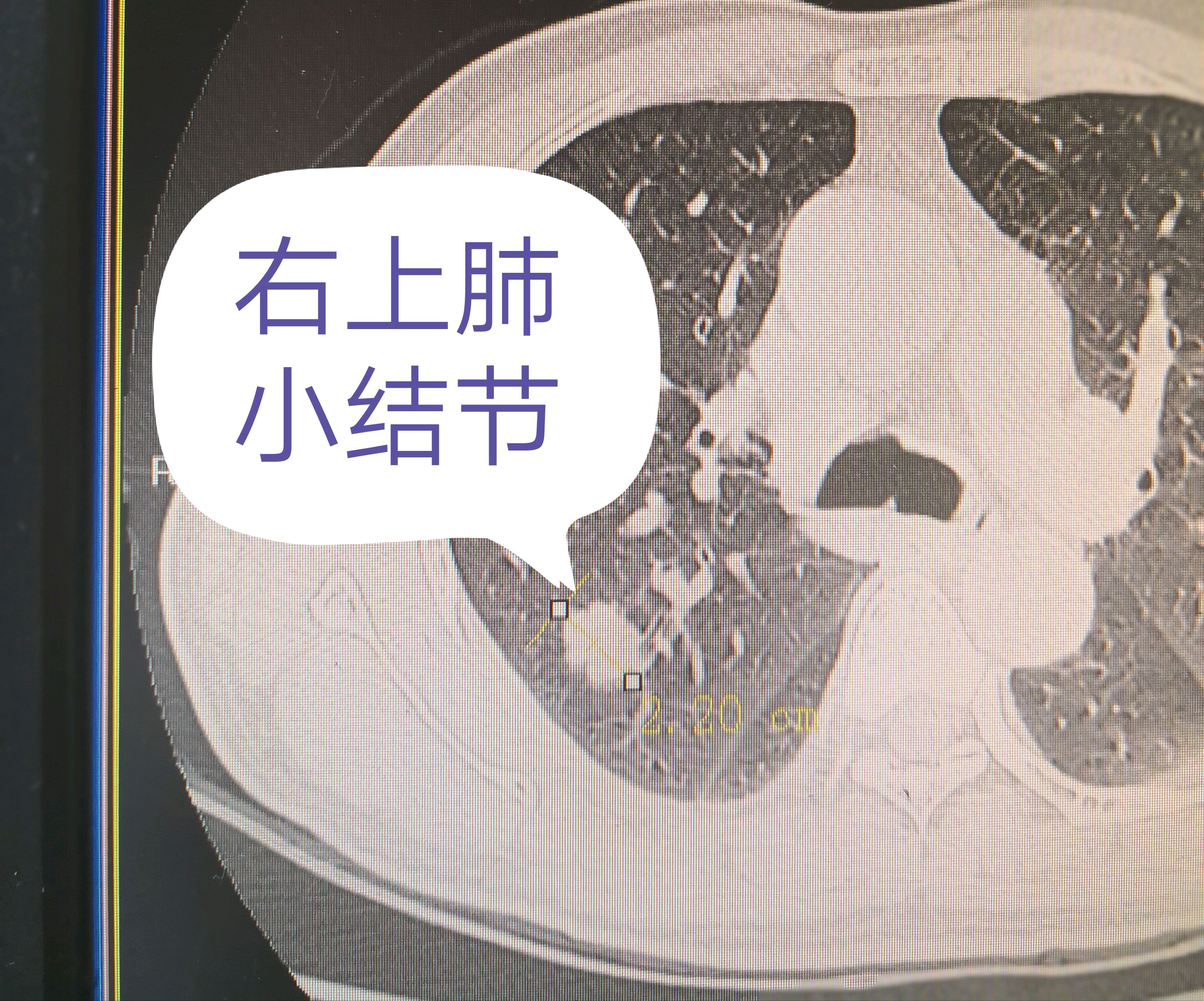 肺部肿瘤胸片图片
