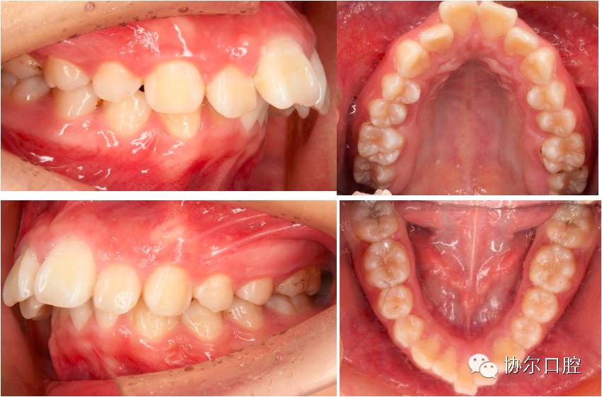 牙弓狭窄,上下前牙突出还有面型问题长久张口呼吸,导致上唇前突,下颌