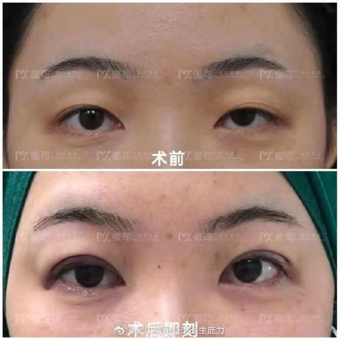 【提肌无力,大小眼矫正,术后即刻反馈】