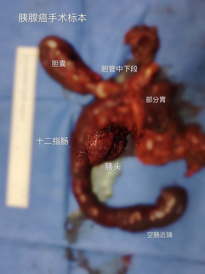 胰头癌手术需要切除6个脏器