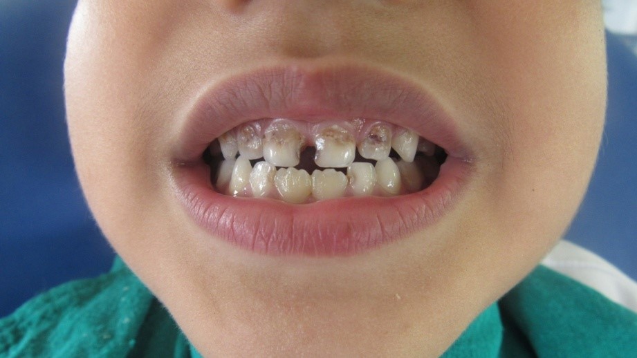 儿童乳牙龋齿问题123