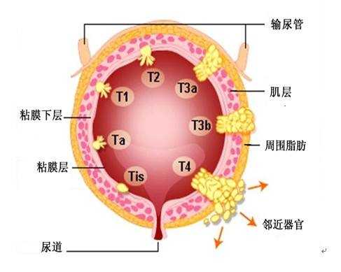 为什么有人说膀胱癌是最"善"的癌?