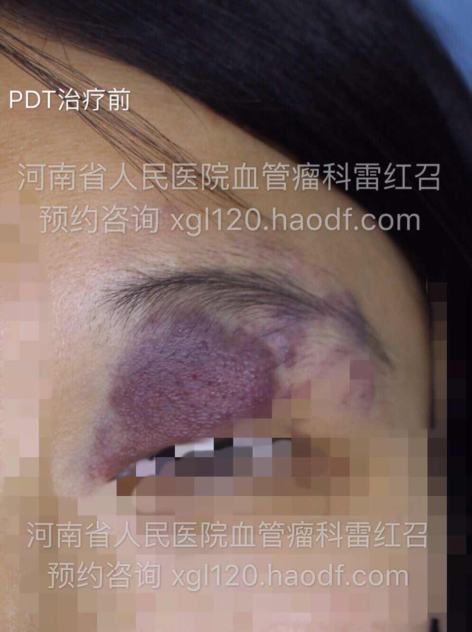 眼睑部难治性鲜红斑痣血管靶向光动力疗法治疗病例展示