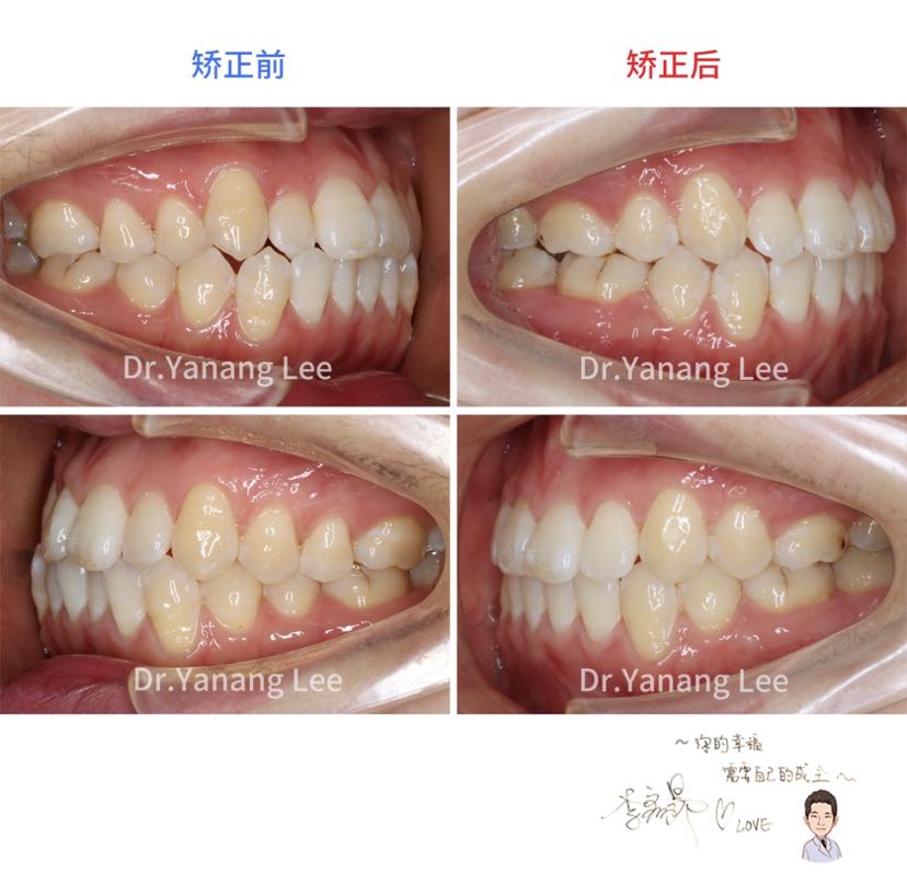 【前牙对刃 侧切牙反颌矫正案例】
