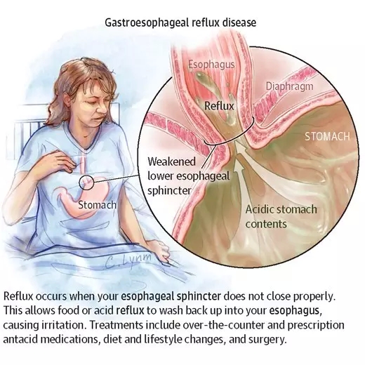 胃食管反流gastroesophagealrefluxdisease