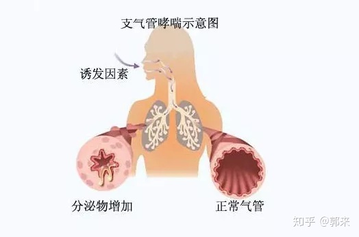 支气管炎症状及表现图片