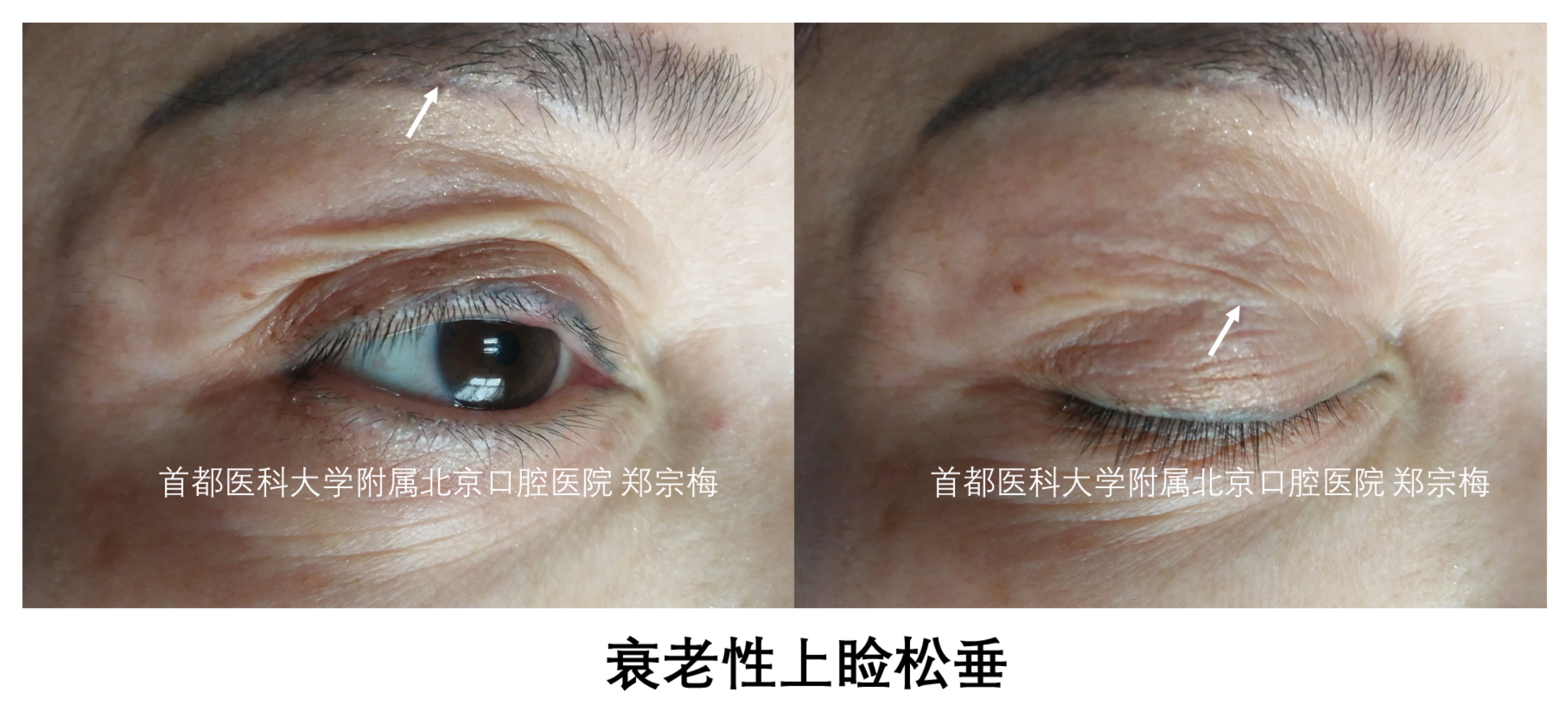 衰老性上睑松垂适合做埋线双眼皮吗?