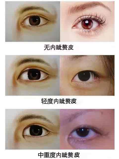 眼睛半月皱襞变大,眼角半月皱襞变大图_大山谷图库