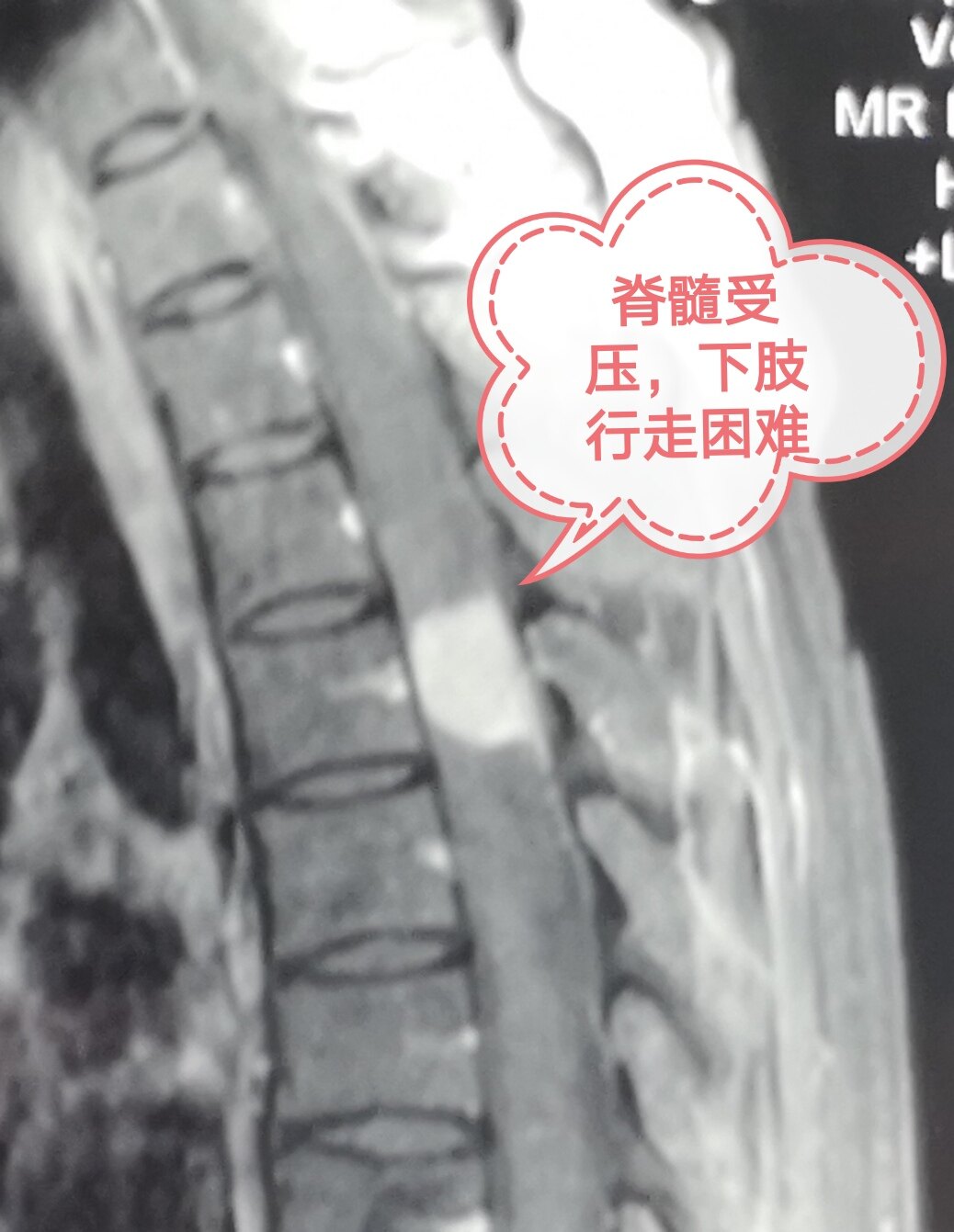 脊髓被肿瘤压迫无法行走,切除术后一周可下地活动