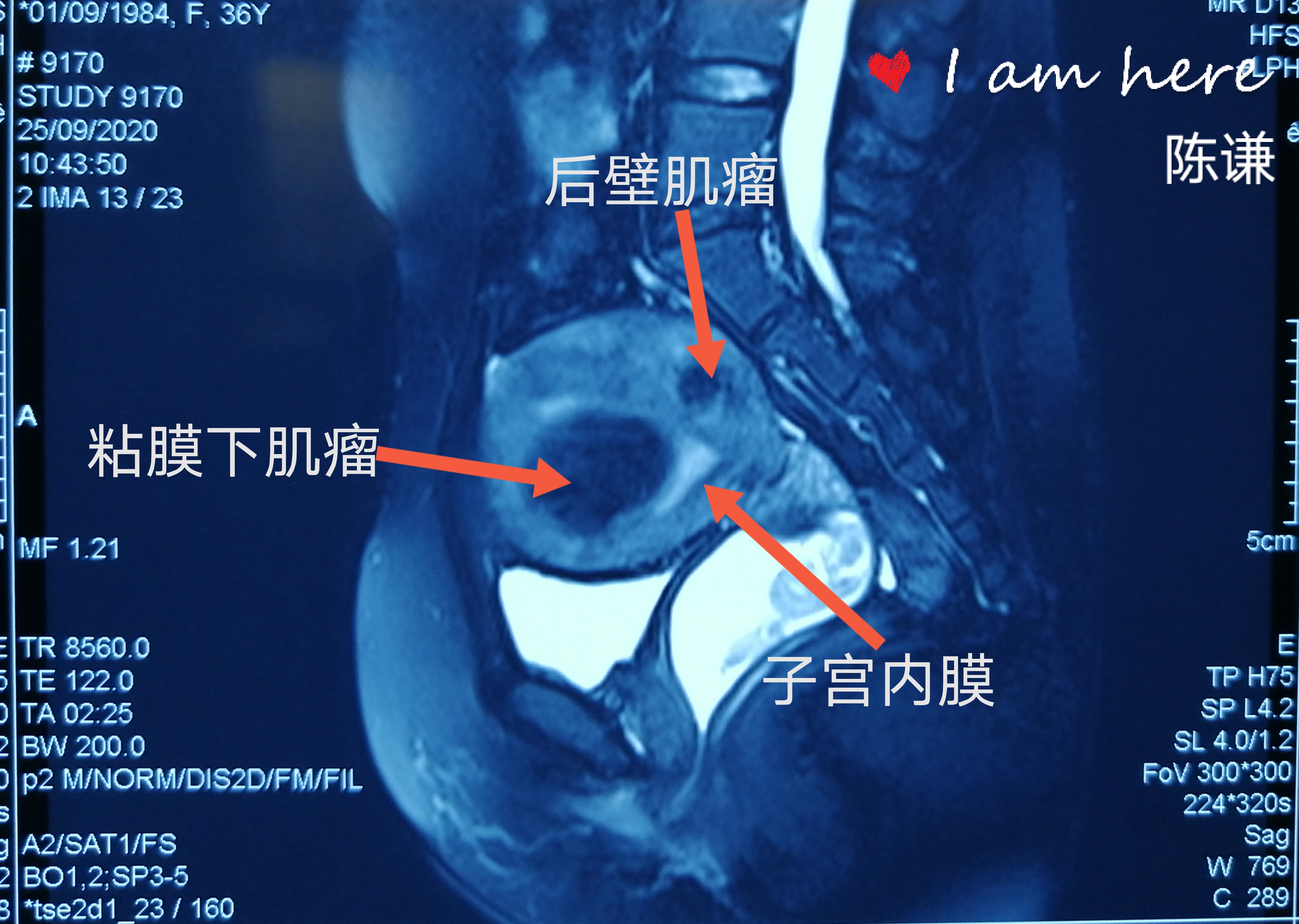 術前磁共振顯示肌瘤共三個,分別我右側漿膜下肌瘤,粘膜下肌瘤和左側後