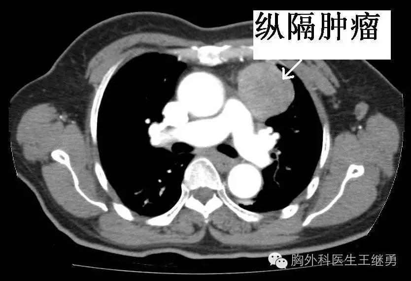 敏感的患者,肿瘤可以很快缩小,像我前文中提到的一位23岁纵隔肿瘤患者