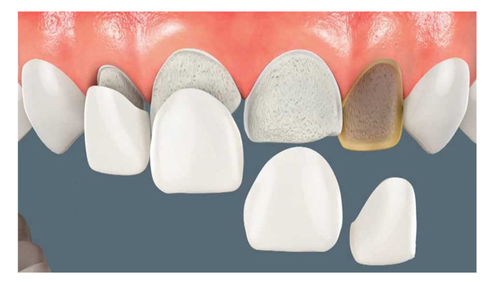 瓷贴面简介七问七答