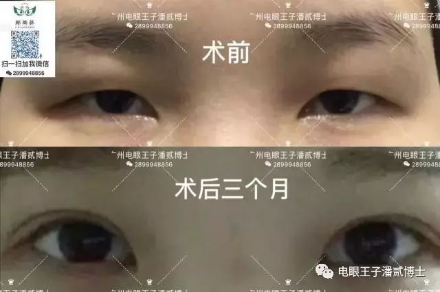 凤姐的眼睛其实也不差.-潘贰主治医师-爱问医生