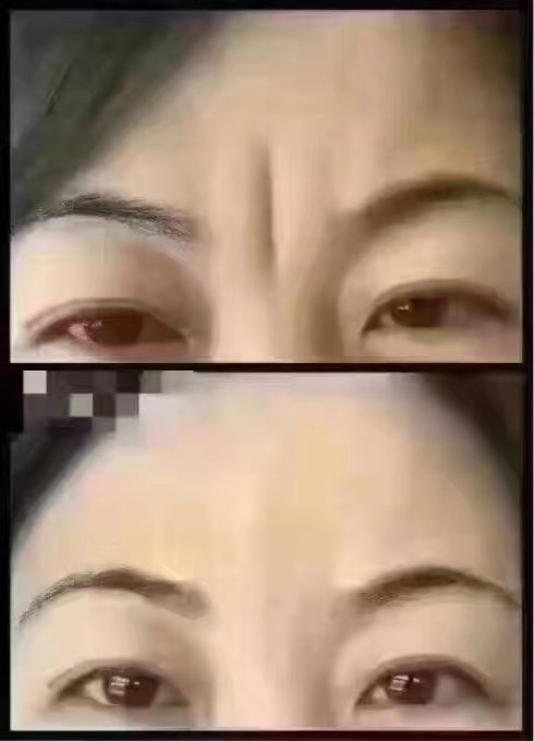 悬针破印挡运势,川字纹不能留!