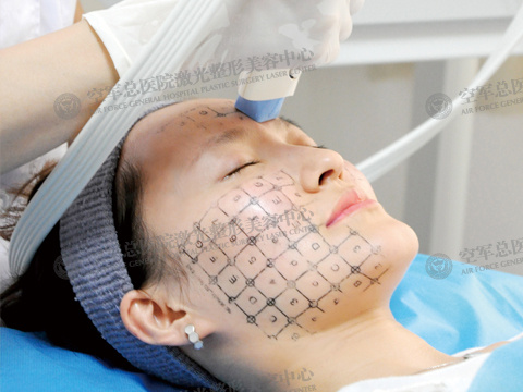 热玛吉抗衰治疗为何只需一次