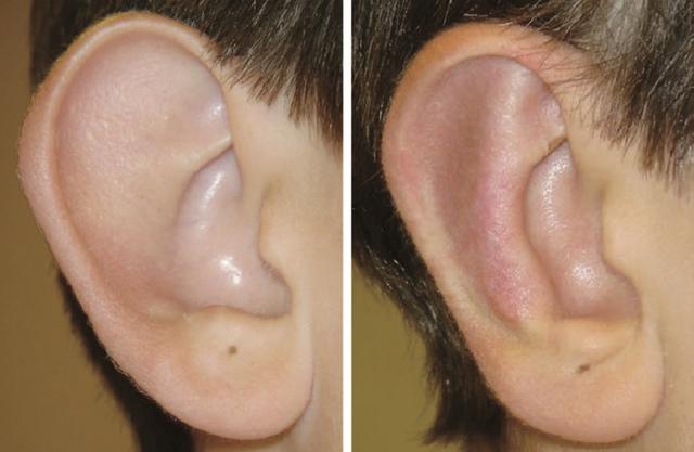 招风耳怎么治疗